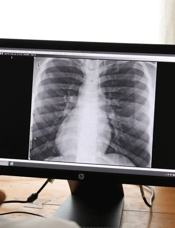 Solthis - Tuberculose